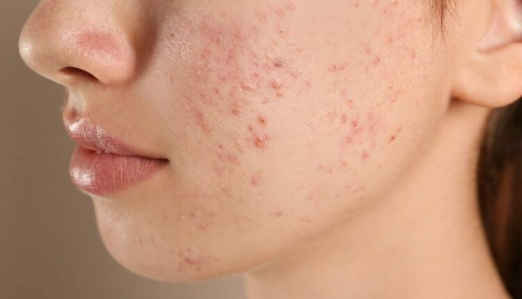Acne